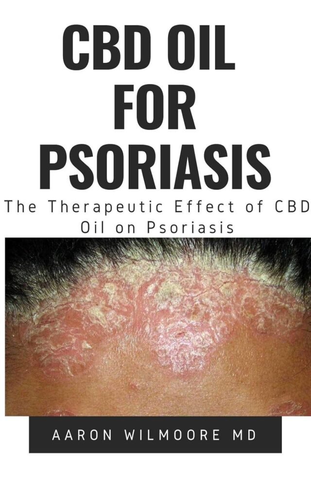 CBD Oil for Psoriasis: All You Need To Know About How CBD OIL WORKS for Treating Dry, Red and Scaly Patches on the Skin     Kindle Edition